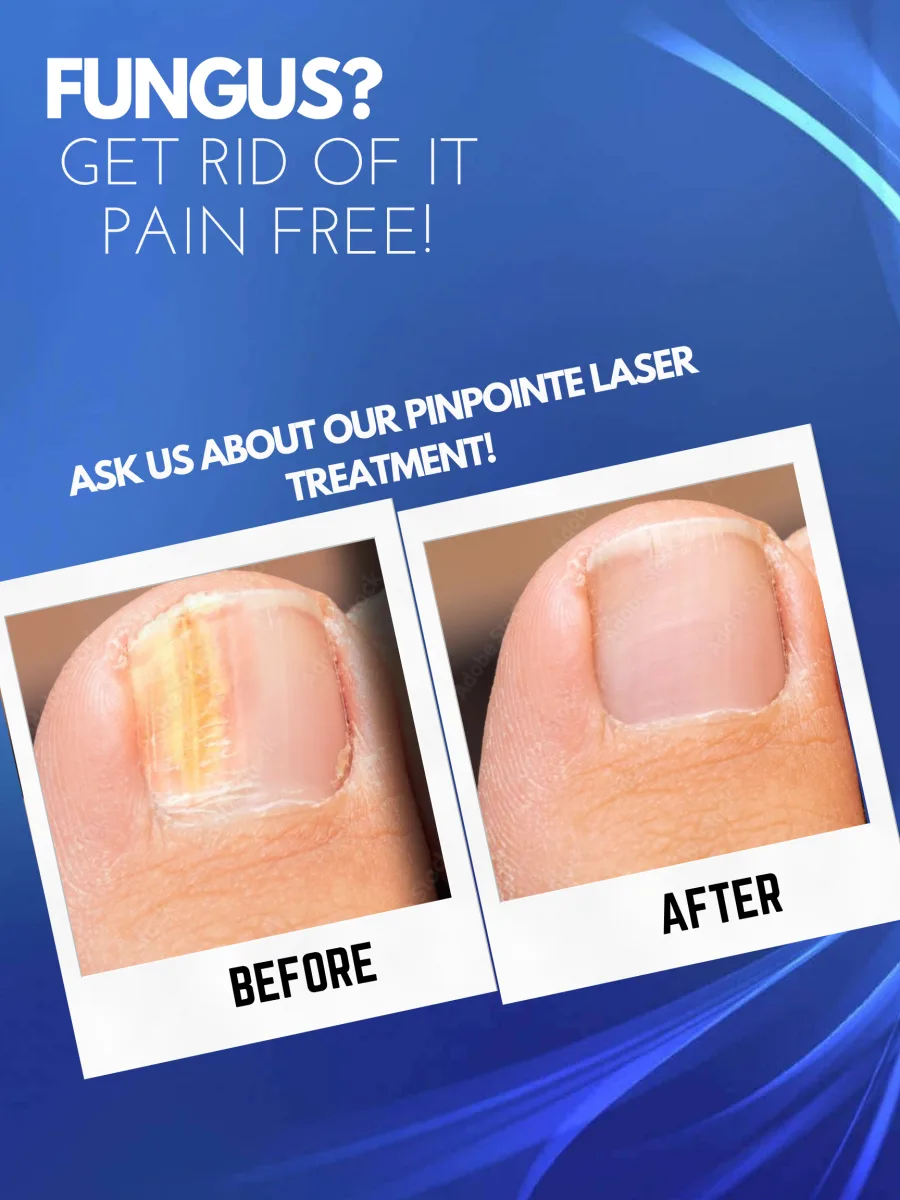 Poster: a fungal toenail before and after PinPointe laser treatment