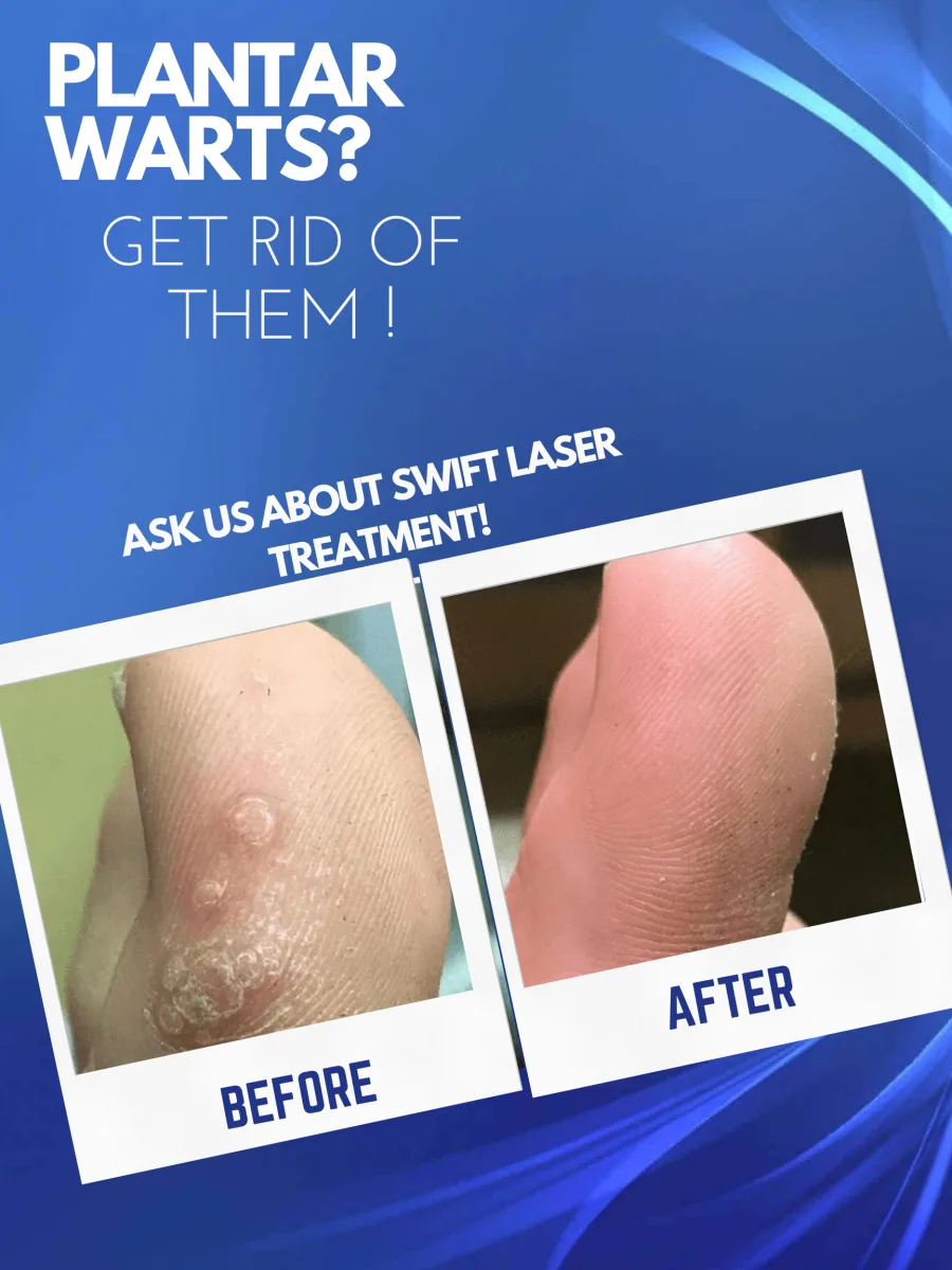 Poster: plantar warts on a heel before and after Swift® microwave therapy
