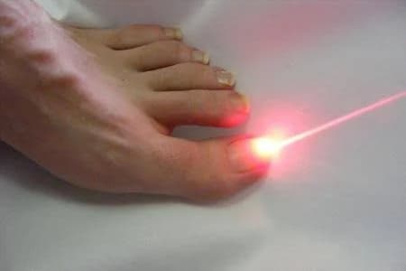 A laser being applied to a toenail to treat nail fungus