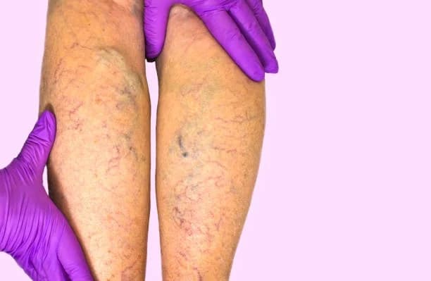 Gloved hands examining lower legs with visible varicose and spider veins