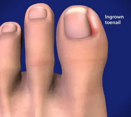 Illustration of an ingrown toenail on the big toe, with redness along the nail edge