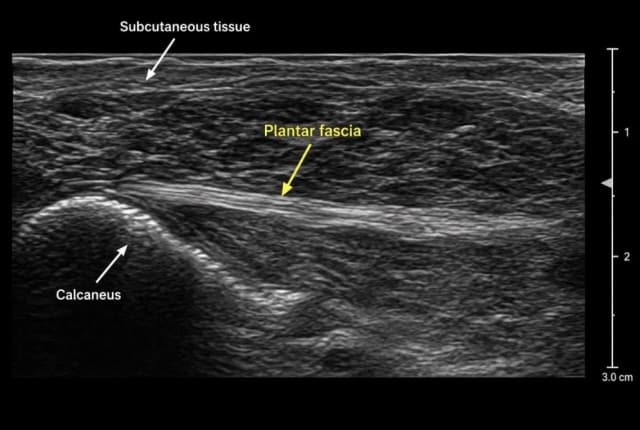 A diagnostic ultrasound image of the heel, labelled to show the plantar fascia, the calcaneus and the tissue under the skin