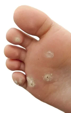 The sole of a foot with several plantar warts